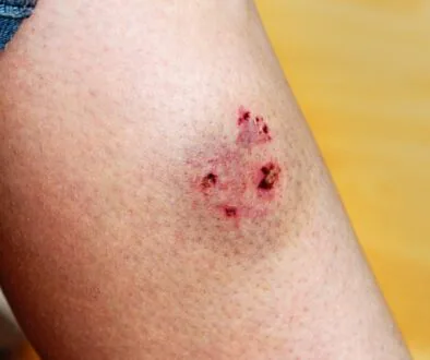 Close-up of a dog bite wound on a person’s leg, showing puncture marks and bruising consistent with a recent bite injury.