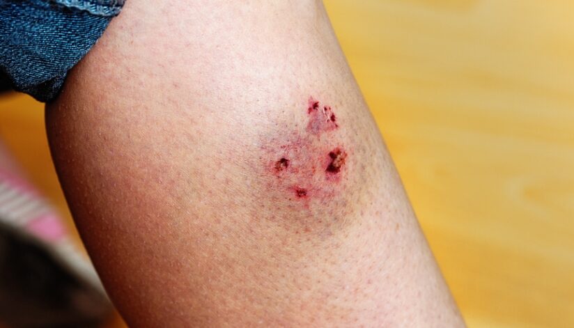 Close-up of a dog bite wound on a person’s leg, showing puncture marks and bruising consistent with a recent bite injury.